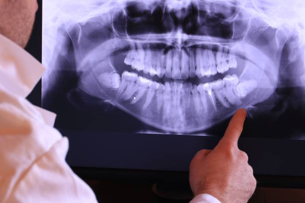 Best Knocked-Out Tooth (Avulsed Tooth) Treatment in Waverly, NY