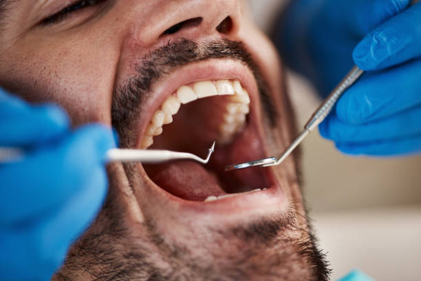 Best Emergency Wisdom Tooth Extraction in Waverly, NY
